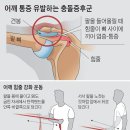 어깨 통증 `초기 진압`하려면… 힘줄 덮은 근육 단련을 이미지