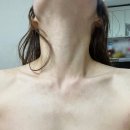 풀독 | 목 전신 두드러기 발진 풀독 접촉성 피부염 성인 다형홍반 치료 후기 진단