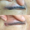 [공지] 오래된 아이라인 고민 저통증 제거하는 양산 나윤뷰티