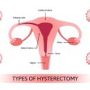 자궁관난소절제술[Salpingo-oophorectomy] 이미지