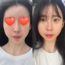 수원신경정신과의원 | 수원 피부과 세모아의원 V슬림핏 레이저 ( 티타늄리프팅+ 윤곽주사) 솔직후기
