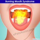 작열감[burning sensation] 이미지