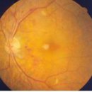 안과 전문의 김효명 교수의 건강 칼럼(5) 당뇨, 고혈압 그리고 눈 이미지