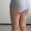 인천 | 허벅지지흡후기, 인천지방흡입 4개월 변화 + 병원 고르는 꿀팁