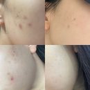 모두한의원 인천구월 | [인천/구월] 여드름 박멸 아그네스 레이저 내돈내산 후기 포메디한의원
