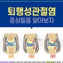 류마티스 관절염 퇴행성 관절염 원인 초기 증상 류마티스관절염 퇴행성관절염 차이점 치료방법 이미지