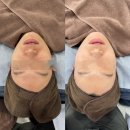인천웨딩케어 슈퍼젝션 후기 부평 피부관리는 리우에스테틱