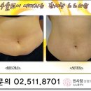 한사랑노노의원 | [ppc후기] 날씬하게 몸매를 만들고 싶다면 ppc주사