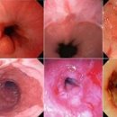 '바렛 식도' 무엇인가 역류성 식도염 ＜차이점＞ 이미지
