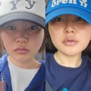 배치 | 부산눈밑지방재배치 후기 제거 + 지방이식 무보정 노메이크업 두달차