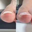 순천 함양 내성발톱 무좀발톱 발각질 관리해주는 더블유뷰티