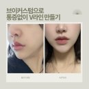 유어타임성형외과의원 | 신사 온다 티타늄 리프팅 후기 뷰티바 성형외과 | 팔자주름, 중안부 처짐 브이턱 리프팅