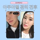 피투케어 | 아쿠아필 관리 받으러 강남역피부과 다녀온 후기!
