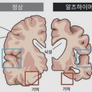 치매관련주, 알츠하이머 임상시험학회 일정과 포인트는!? (프롬바이오, 메디프론, 젬백스, 샤페론, 차바이오텍) 이미지