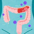 컨빈 | 장루 종류별 초기 관리 포인트: 회장루·결장루 차이와 수술 직후 관리