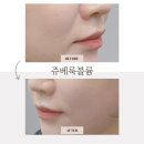 서울 강남 피부과 쥬베룩볼륨 팔자주름 솔직후기