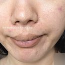 강경약국 | 아젤리아 디페린겔 내돈내산 약국템 흉터 효과 좁쌀 여드름 모낭염 영양제 일기