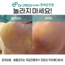 닥터페디(동래온천점) | 동래 발각질, 더 이상 혼자 고통받지 마세요 – 닥터페디 동래온천점이 제대로 도와드립니다