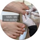 대구발톱무좀 고민? 수성구 발톱무좀 스케링 후기- 모모뷰티&amp;발톱전문가