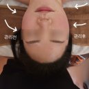 사우동 두피관리 피부관리 동시에 더블유에스테틱 두피리프팅 효과