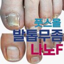 부작용 없이 엄지발톱무좀 없애는 방법 알아보기 나노에프 NanoFungus-풋스올강남역삼선릉