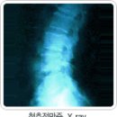 [허리디스크 원인과 증상] - 허리 디스크가 동반하기 쉬운 증상들 이미지