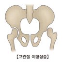 근골격질환, 소아청소년질환 고관절 이형성증 (DDH (developmental dysplasia of the hip)) 이란? 이미지