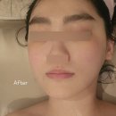 필수 승모근 윤곽관리 여기서 해결❤️ 비포애프터 사진 있음! 입소문난 동작피부관리 소녀피부로 방문 후기🎶