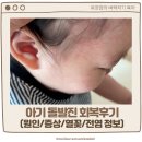 유일어린이집 | 아기 돌발진 회복후기 증상 열꽃 어린이집 전염 정보