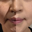 엘라비 | 팔자주름시술, 팔자주름리프팅, 마리오네트주름시술 유스 자가진피재생술 후기요~!!!