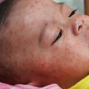홍역(Measles)의 원인. 증상. 예방. 치료 이미지