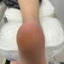 장기역 | 출산 후 발각질관리 레푸스 김포장기역점 방문후기