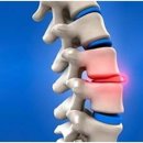 [추간판탈출증]추간판탈출증 증상과 치료방법 이미지