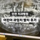 가야치과병원 | [공지] 아이 과잉치 발치 전신마취 없이 인천 치과병원 수면마취 수술 비용 실비청구