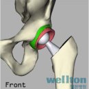 대퇴골두무혈성괴사/고관절수술/고관절인공관절 이미지