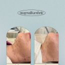 독정로 | [검단에스테틱] 턱·등 트러블 고민 해결✨ 원데이필 1회 시술 리얼 후기 (비포 에프터 공개)