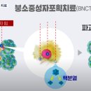 뇌 종양의 새로운 치료 , 암 표적 입자 치료 붕소중성자 포획 치료 (BNCT) 이미지