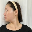 압구정역피부과 에이포의원 온다리프팅 6만줄 후기