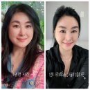 압구정 리투오(Re2O)스킨부스터 10일후 통증 효과 솔직한 찐 후기｜(압구정역) 오퍼스클리닉/ 의원