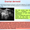 ovarian dermoid 이미지