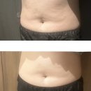 서면3 | 서면다이어트 지방분해주사 3회차 후기(+전/후 사진)