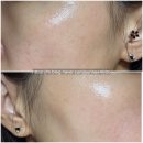 마크성형외과의원 | [리뷰] 동탄 에미뜨의원 리팟제거 후기 2탄｜2주 관리 후 깔끔하게 사라진 색소!