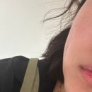 [내돈내산] 광주 보조개 수술 후 8개월 후기
