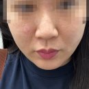 점 | [울산공업탑][내돈내산] 아프지 않았던 점제거후기+ 꿀 TIP