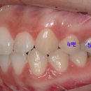 돌출입 교정 20 - 잇몸돌출, 5번 발치 이미지