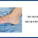 UR(의정부시)-[평화로]-하-48 | 엄지발가락 휨, 무지외반증 4세대 MITA 수술사례 (족부전문의 작성) [의정부 족부병원]
