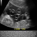 Single umbilical artery (SUA) or 2 vessel umbilical cord 이미지