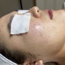 브이팜 | [아크핏] 여드름에 효과좋은 기초템 추천 | 내돈내산 | 브메스팜 | 브이메디스파 피부과