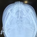 더강추정형외과의원 | 수원 아주대병원 성형외과에 가기까지의 여정 (+강남 더강추정형외과의원, 2동탄 센트럴정형외과의원 )