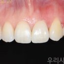 치아사랑기공소 네이버블로그